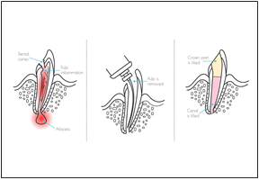 Regenerative Endodontics