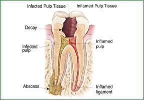 Root Canal Treatment