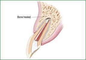 Endodontic MicroSurgery